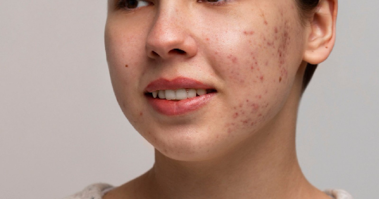 Skin Pigmentation Treatment In Bangalore
